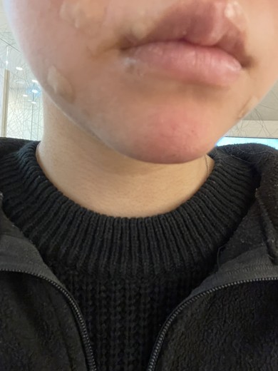 after photo: 턱끝보톡스, 턱끝필러