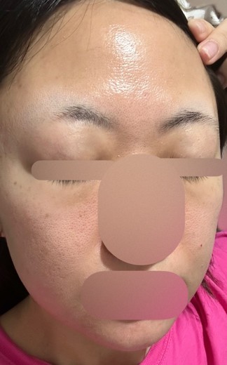 after photo: ララピール(LHAピーリング)