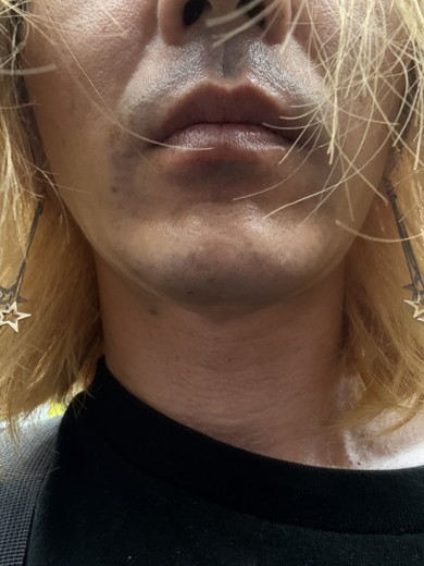 before photo: 턱제모, 인중제모