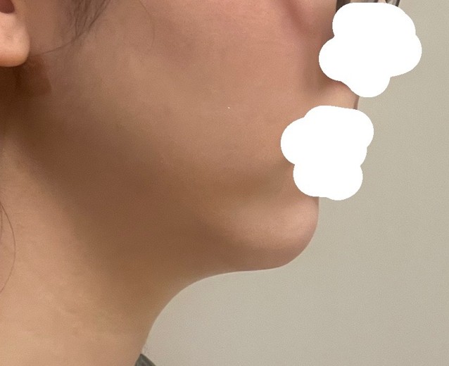 after photo: 脂肪吸引(顎下)