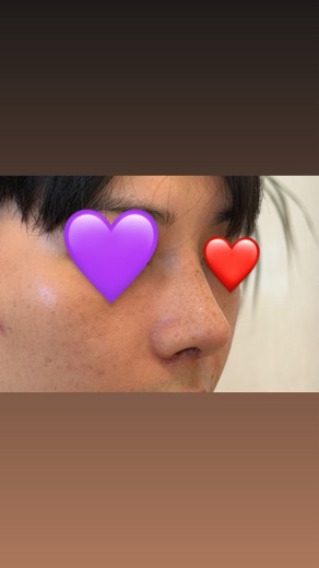 after photo: 콧대(자가조직), 코끝(보형물)