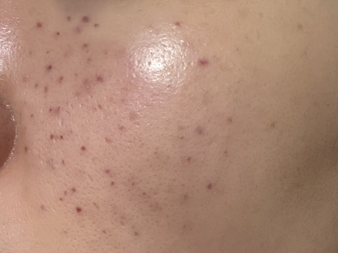 after photo: 리쥬란힐러