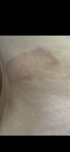 after photo: 脂肪冷却(脇腹), 脂肪冷却(お尻)