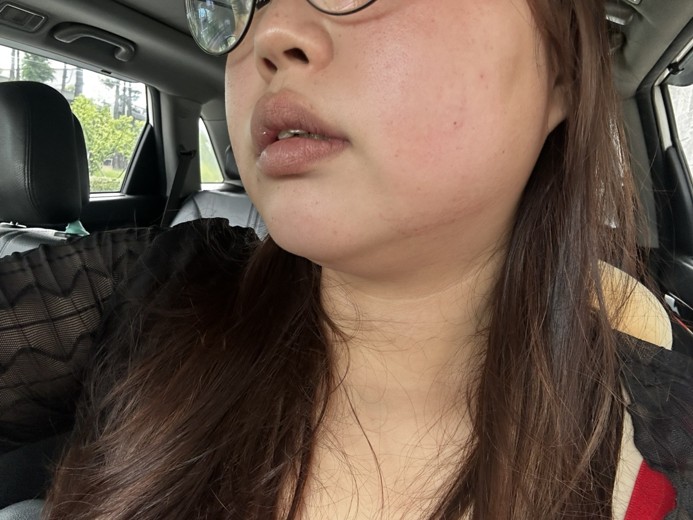 after photo: 아쿠아필링