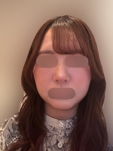 after photo: スキンボトックス, ポテンツァ(POTENZA)
