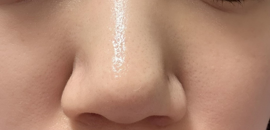 after photo: 小鼻ボトックス, 脂肪溶解注射(顔)