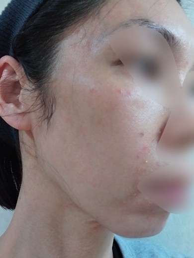 after photo: IPL(光/フォト治療)