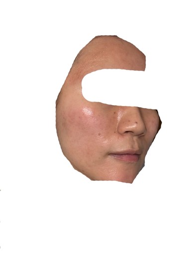 before photo: ダーマペン