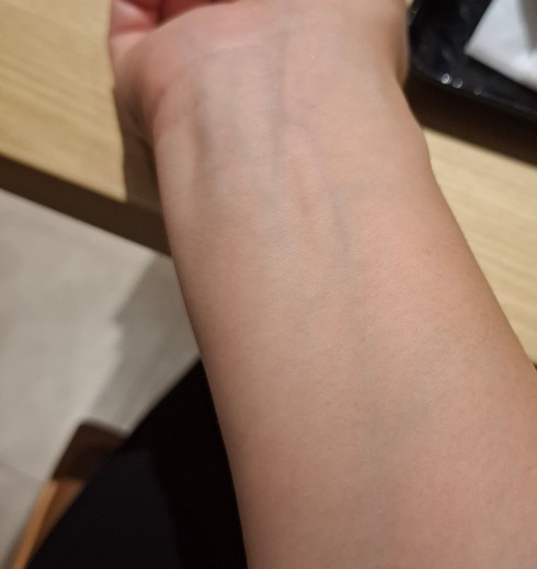after photo: 白玉注射・点滴