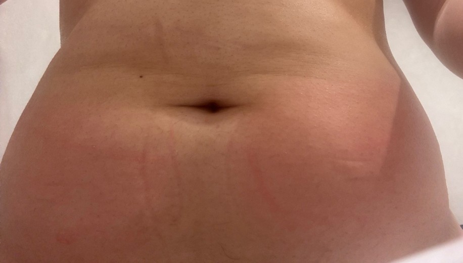 after photo: 脂肪冷却(腹部)
