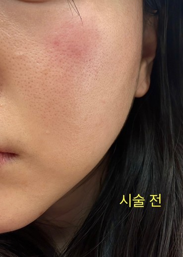 before photo: 쥬베룩