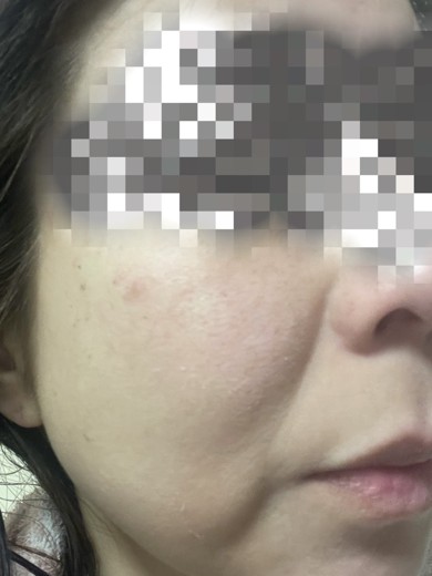 after photo: ピーリング, ルメッカ