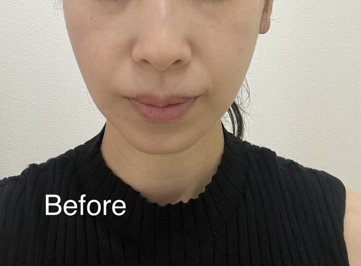 before photo: チタニウムリフト