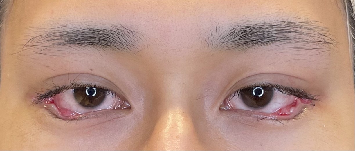 after photo: タレ目形成, 目尻切開