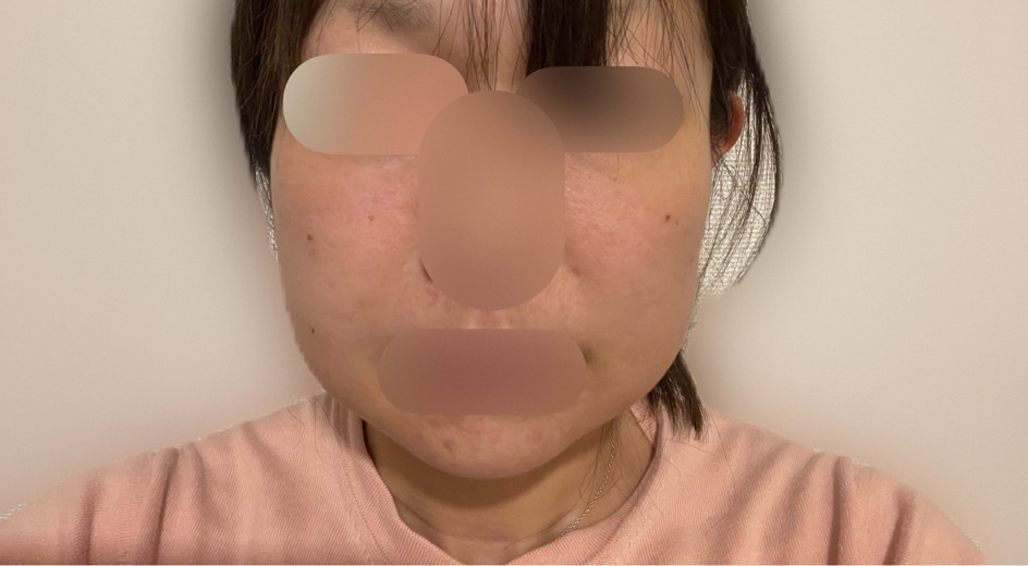 after photo: 脂肪溶解注射(顔)