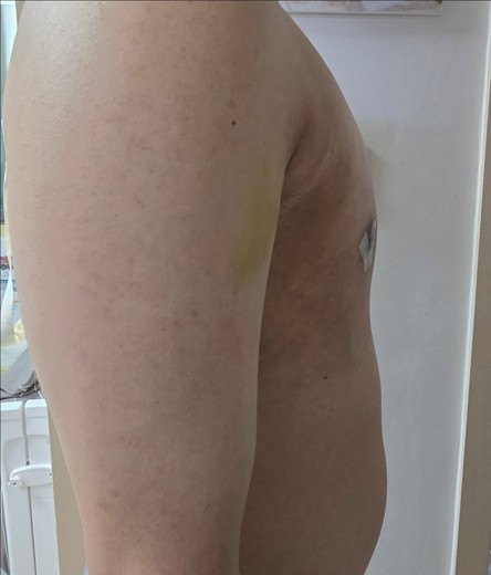 after photo: 여유증수술