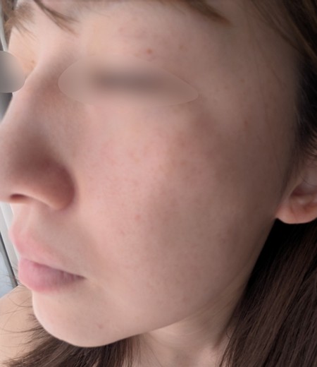 before photo: IPL(光/フォト治療), ピーリング