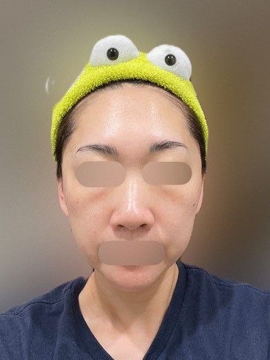 after photo: ヴェルベットスキン