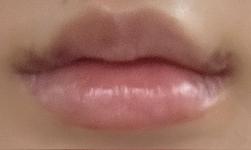 after photo: 입꼬리필러, 입꼬리보톡스, 입술필러