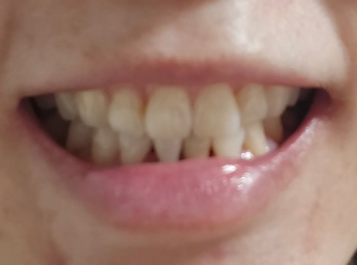 after photo: 치아미백