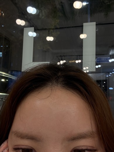 after photo: 관자놀이필러