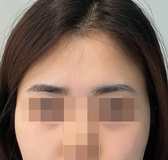 before photo: 이마필러