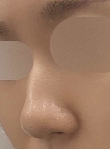 before photo: 콧대(보형물), 코끝(자가연골), 복코교정(수술)