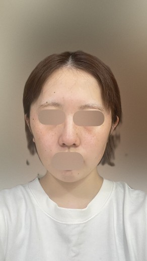 after photo: イオン導入