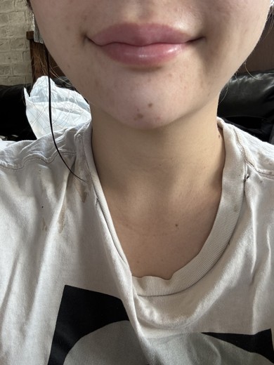 after photo: 脂肪吸引注射
