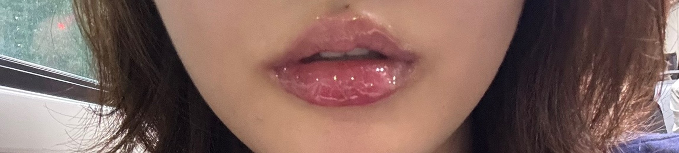 after photo: 입술필러