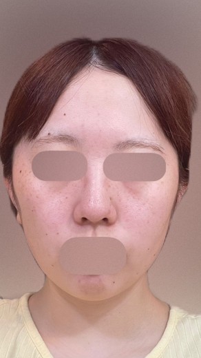 after photo: イオン導入