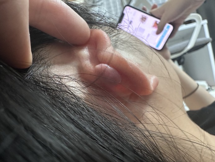 before photo: 캘로이드귀성형