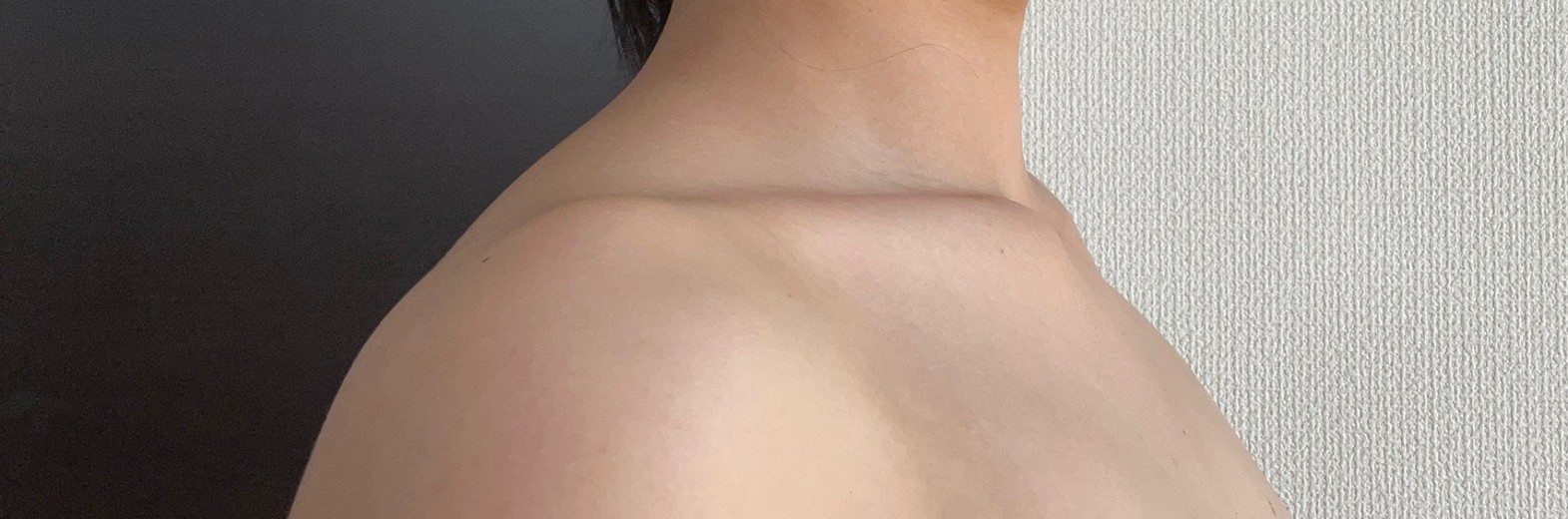after photo: 脇ボトックス, エラボトックス, 肩ボトックス(僧帽筋)