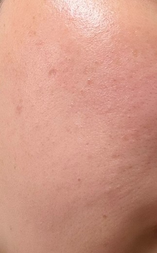 before photo: IPL(光/フォト治療)