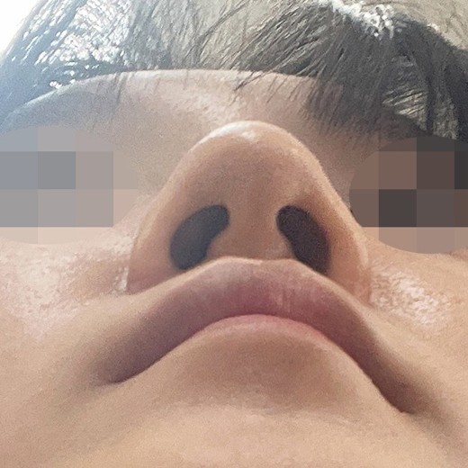 after photo: 콧볼축소