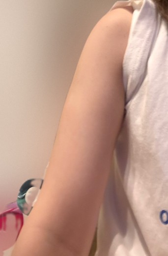 after photo: 脂肪冷却(腕)