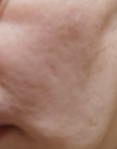after photo: IPL(光/フォト治療)