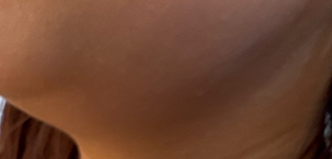 after photo: 脂肪溶解注射(脇腹), 脂肪溶解注射(顔)