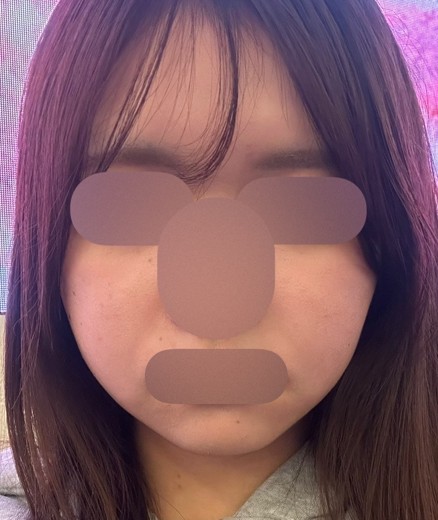 before photo: インモード