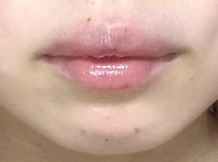 after photo: 口角ボトックス