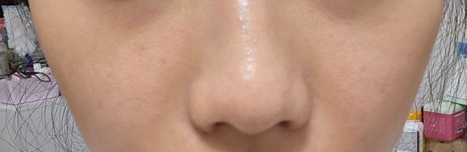 after photo: 콧볼축소