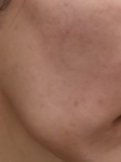 after photo: IPL(光/フォト治療)