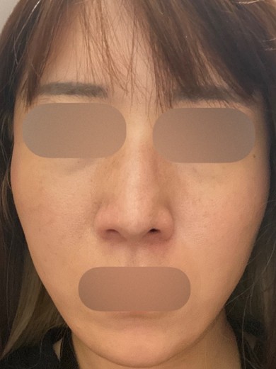 after photo: フラクショナルレーザー, ピコトーニング, 診断・検査