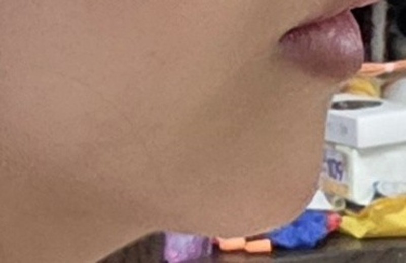 after photo: 입술필러