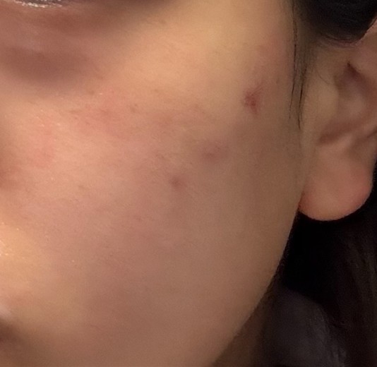 before photo: エレクトロポレーション, ララピール(LHAピーリング)