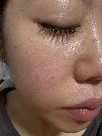 after photo: IPL(光/フォト治療), ルメッカ