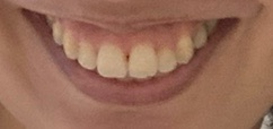 before photo: ホワイトニング