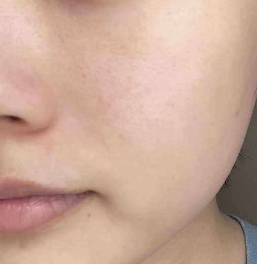 after photo: IPL(光/フォト治療), ルメッカ