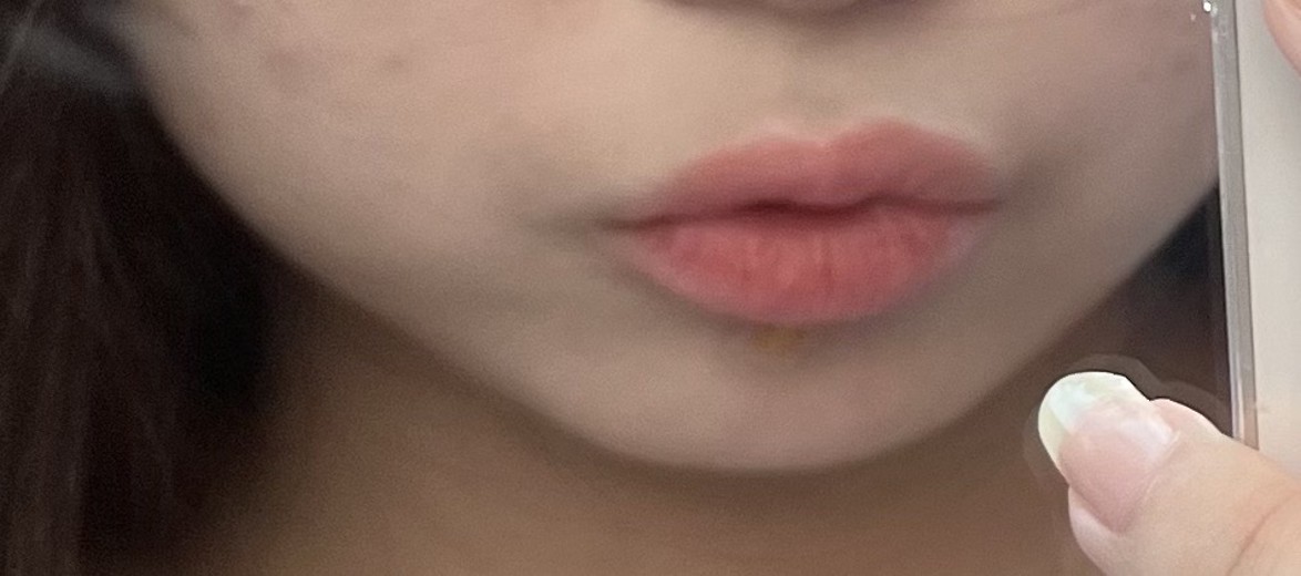 before photo: 윤곽주사, 사각턱보톡스