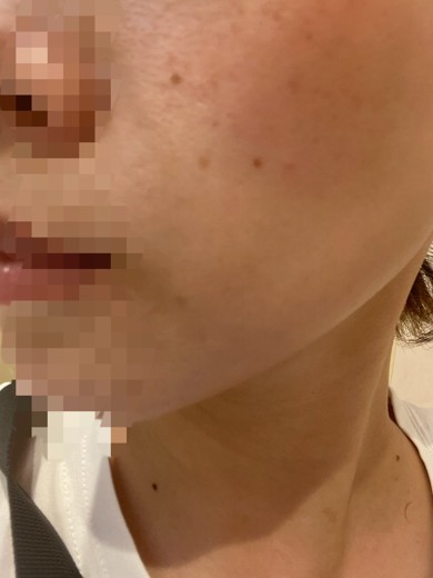 after photo: IPL(光/フォト治療), ピーリング